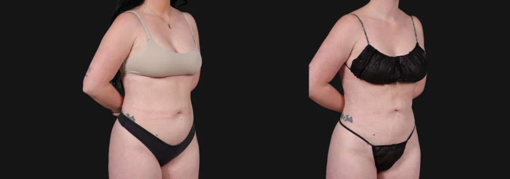 Liposuction case #266707