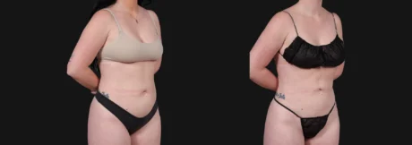 Liposuction case #266707