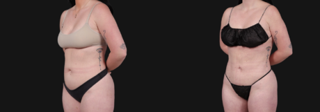 Liposuction case #266707