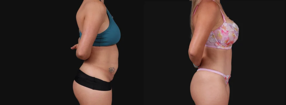 Tummy Tuck case #267125