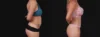 Tummy Tuck case #267125 slider thumbnail