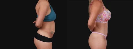 Tummy Tuck case #267125