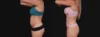 Tummy Tuck case #267125 slider thumbnail