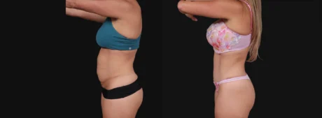 Tummy Tuck case #267125