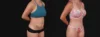 Tummy Tuck case #267125 slider thumbnail