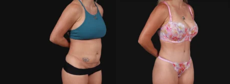 Tummy Tuck case #267125