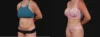 Tummy Tuck case #267125 slider thumbnail