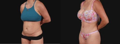 Tummy Tuck case #267125
