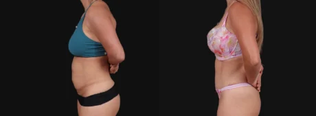 Tummy Tuck case #267125