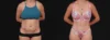 Tummy Tuck case #267125 slider thumbnail