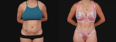 Tummy Tuck case #267125