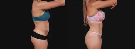 Tummy Tuck case #267125