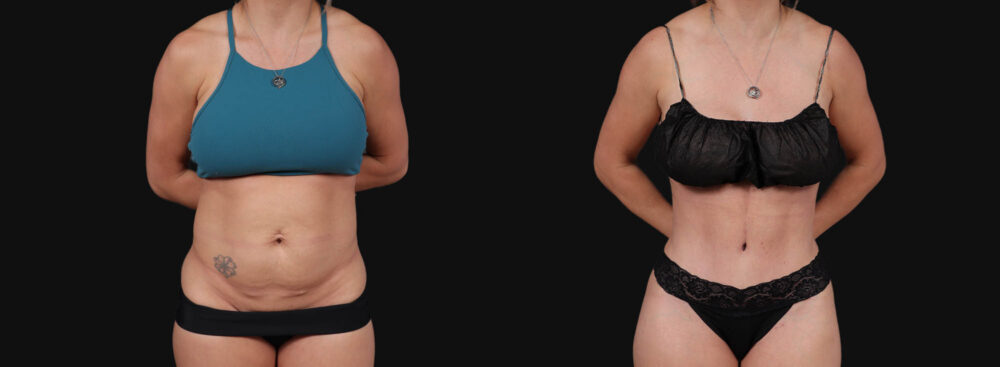 Tummy Tuck case #267125