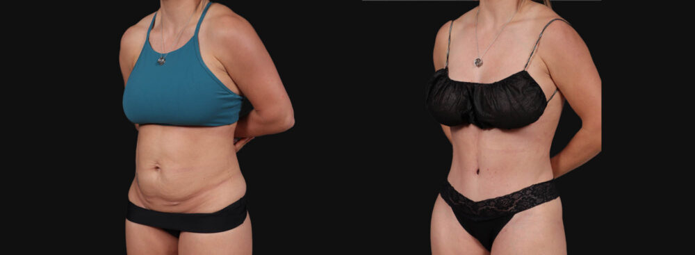 Tummy Tuck case #267125