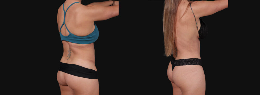 Tummy Tuck case #267125