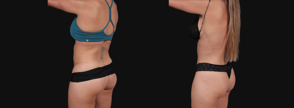 Tummy Tuck case #267125