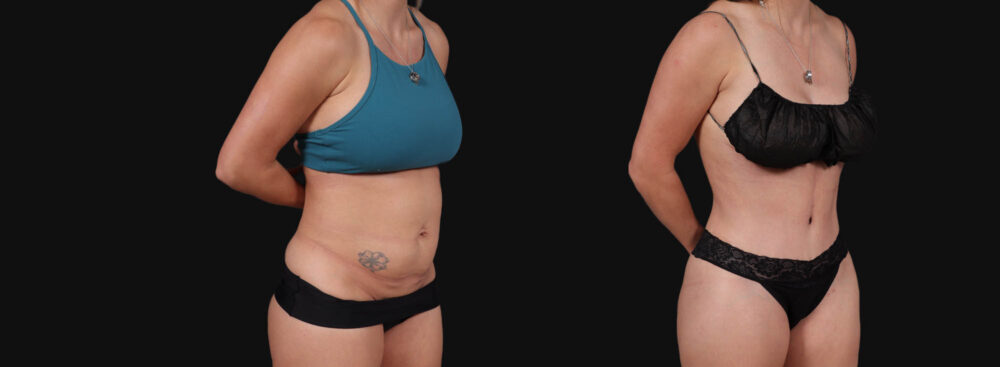 Tummy Tuck case #267125