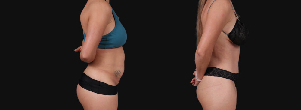 Tummy Tuck case #267125