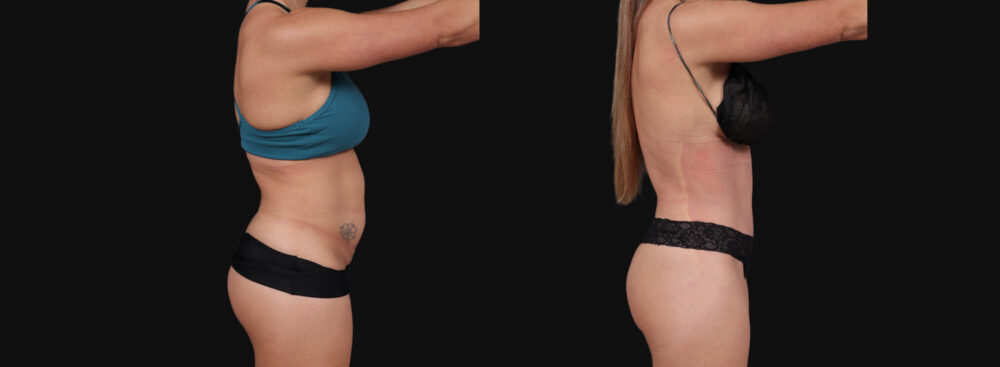 Tummy Tuck case #267125
