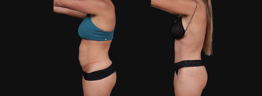 Tummy Tuck case #267125