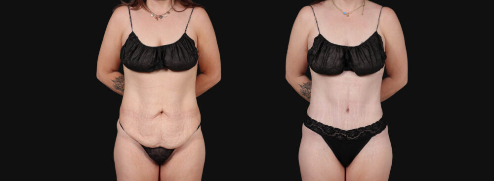 Tummy Tuck case #267116