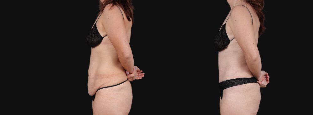 Tummy Tuck case #267116