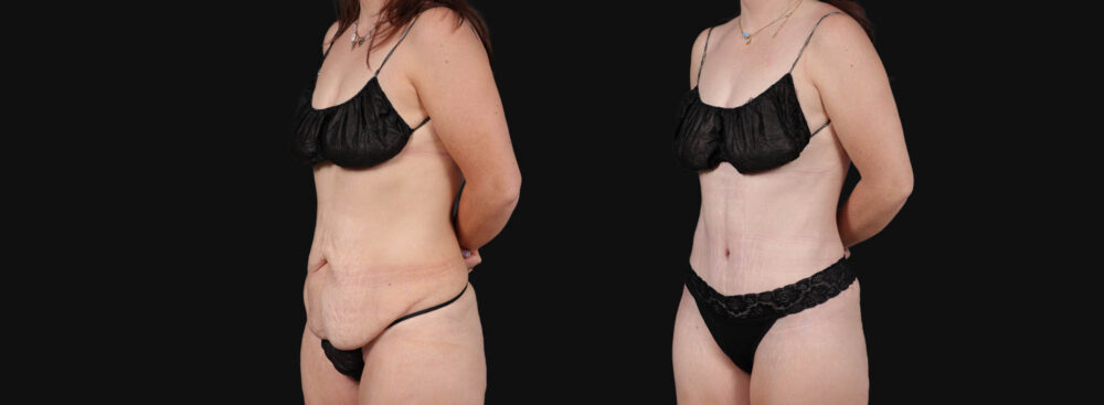 Tummy Tuck case #267116