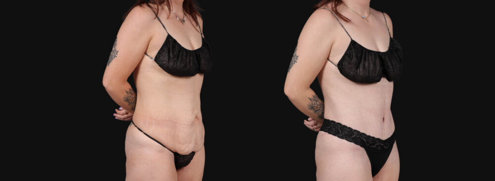 Tummy Tuck case #267116