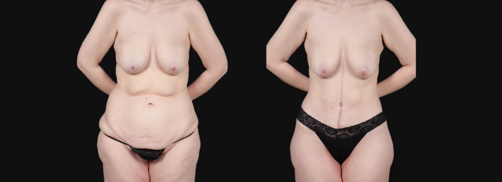 Post Bariatric Surgery (Massive Weight Loss) case #266874