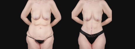 Post Bariatric Surgery (Massive Weight Loss) case #266874