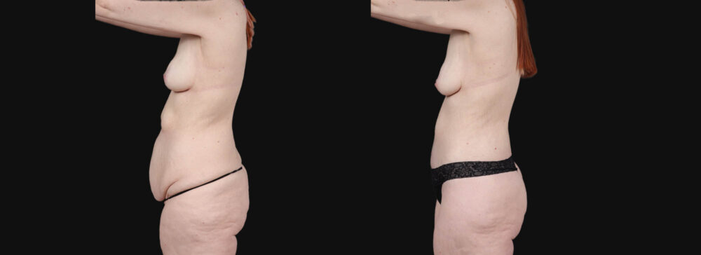 Post Bariatric Surgery (Massive Weight Loss) case #266874