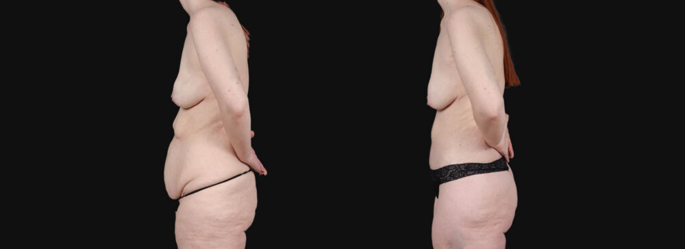 Post Bariatric Surgery (Massive Weight Loss) case #266874