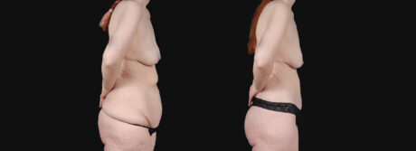 Post Bariatric Surgery (Massive Weight Loss) case #266874