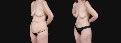 Post Bariatric Surgery (Massive Weight Loss) case #266874