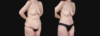 Post Bariatric Surgery (Massive Weight Loss) case #266874 slider thumbnail