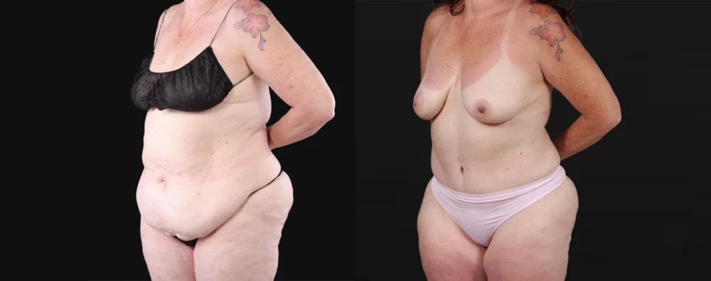 Post Bariatric Surgery (Massive Weight Loss) case #267139