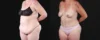 Post Bariatric Surgery (Massive Weight Loss) case #267139 slider thumbnail