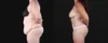Post Bariatric Surgery (Massive Weight Loss) case #267139 slider thumbnail