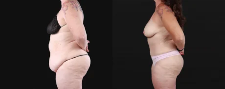 Post Bariatric Surgery (Massive Weight Loss) case #267139