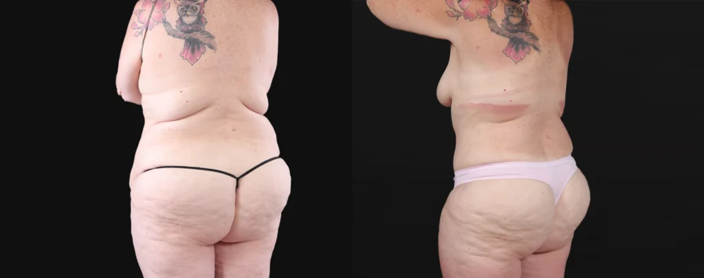 Post Bariatric Surgery (Massive Weight Loss) case #267139
