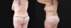 Post Bariatric Surgery (Massive Weight Loss) case #267139 slider thumbnail