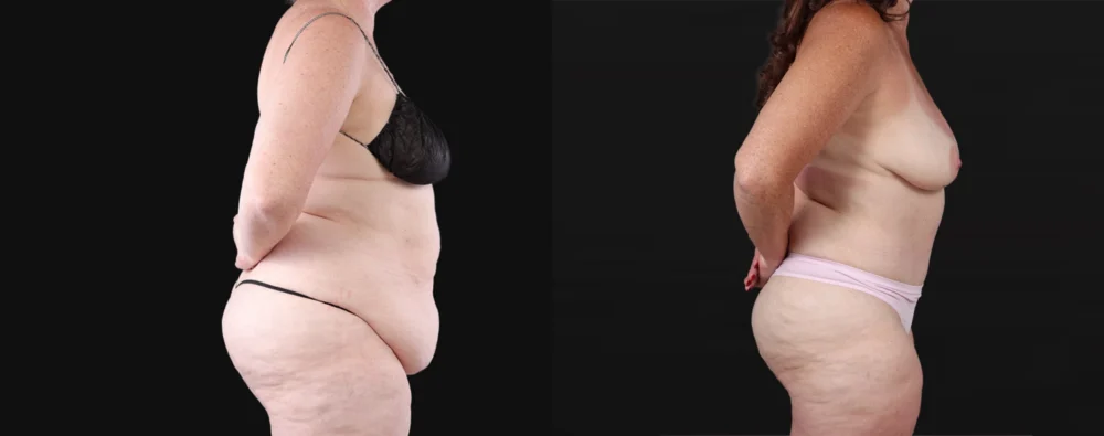 Post Bariatric Surgery (Massive Weight Loss) case #267139