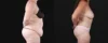 Post Bariatric Surgery (Massive Weight Loss) case #267139 slider thumbnail