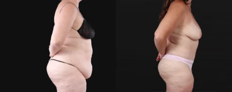 Post Bariatric Surgery (Massive Weight Loss) case #267139