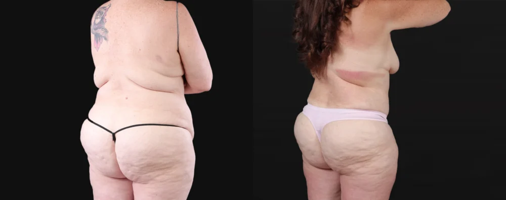 Post Bariatric Surgery (Massive Weight Loss) case #267139