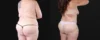 Post Bariatric Surgery (Massive Weight Loss) case #267139 slider thumbnail