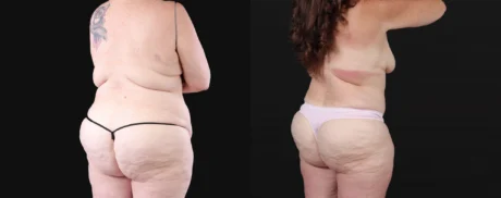 Post Bariatric Surgery (Massive Weight Loss) case #267139