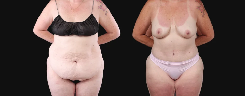 Post Bariatric Surgery (Massive Weight Loss) case #267139