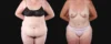Post Bariatric Surgery (Massive Weight Loss) case #267139 slider thumbnail