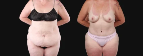 Post Bariatric Surgery (Massive Weight Loss) case #267139